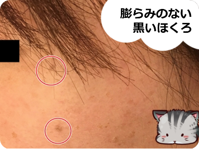 写真あり ほくろ除去後は再発するのか検証 原因と確率は そるとのしっぽ